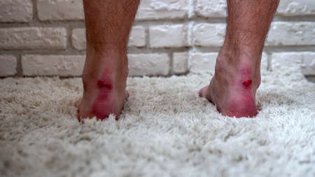 Legs in blood wounds. Rubbed Achilles with a bone wound from a shoe. Shoes rub against the bone.