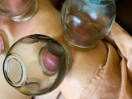 Close up of Thai massage by vacuum cupping therapy. Relaxing rehab massage. Body toxic detoxify