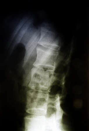 X-ray of the spinal column.の写真素材