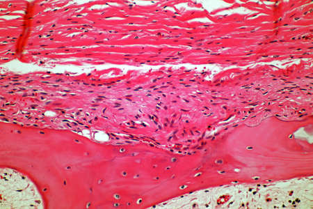 Microscope of Adenoid cystic carcinoma, rare type of cancer exist in many different body sites. This...