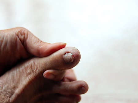 Close up of human hand with dry skin on nails. Selective focus.の写真素材