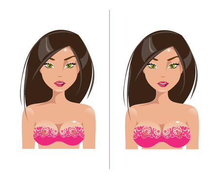 Woman before and after plastic surgery breast augmentationのイラスト素材