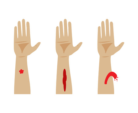 Types of bleeding. Capillary, venous and arterial bleedingのイラスト素材