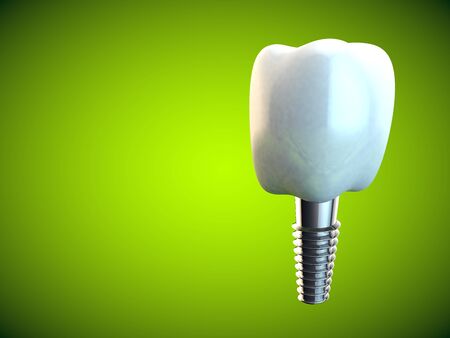 Tooth molar implant Dental Hygiene Dentist 3D rendering greenの写真素材