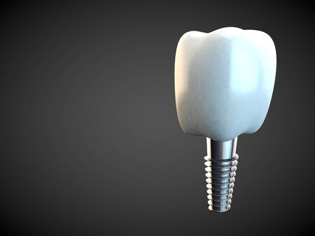 Tooth molar implant Dental Hygiene Dentist 3D rendering blackの写真素材