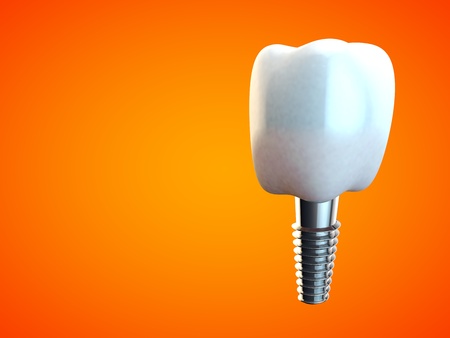 Tooth molar implant Dental Hygiene Dentist 3D rendering orangeの写真素材