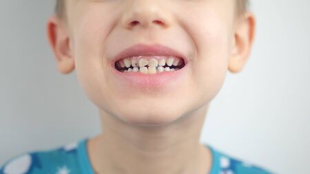 Portrait of a boy in pajamas, bad teeth, closeup.