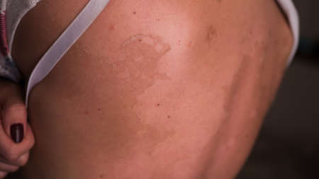 Exfoliation of the skin after sunburn. Excessive tan. The effects of sunburn on the skin. Climb skin