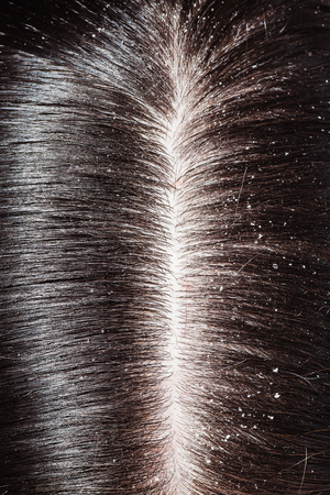 A woman's unhealthy dry head skin closeの写真素材