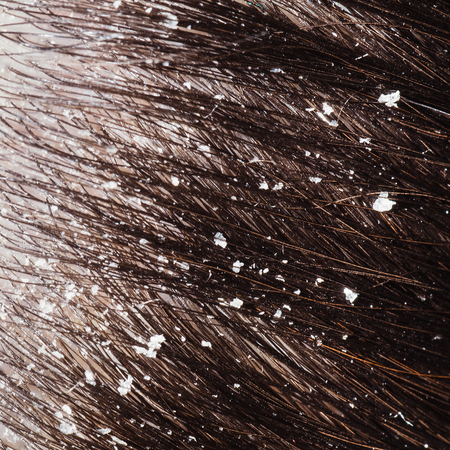 The disease of the scalp in the form of dandruffの写真素材