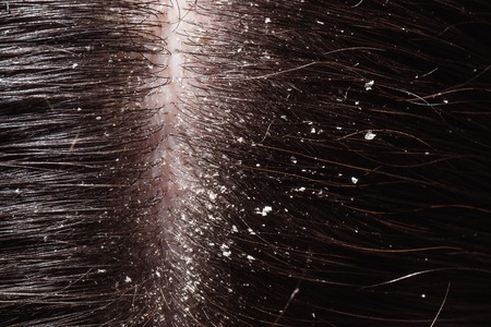 A woman's unhealthy dry head skin closeの写真素材