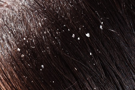 The disease of the scalp in the form of dandruffの写真素材