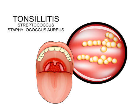 illustration of the inflammatory diseases of the throat