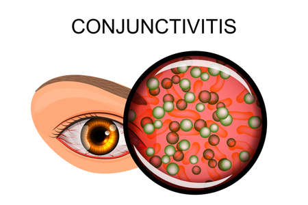 illustration of a healthy eye, the patient with conjunctivitis and styesのイラスト素材