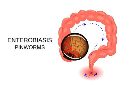 illustration of the intestine suffering from enterobiasis