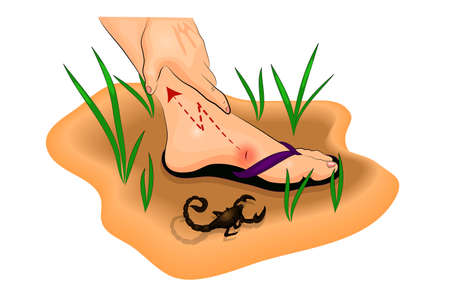 illustration of a Scorpion sting on the footのイラスト素材