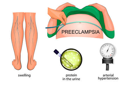 the symptoms of eclampsia during pregnancy: swelling of the feet, hypertension and protein in the urineのイラスト素材