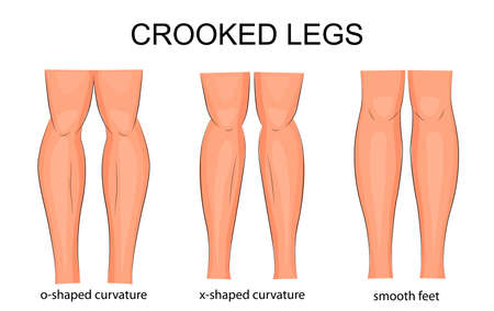 illustration of types of curvature of the legsのイラスト素材