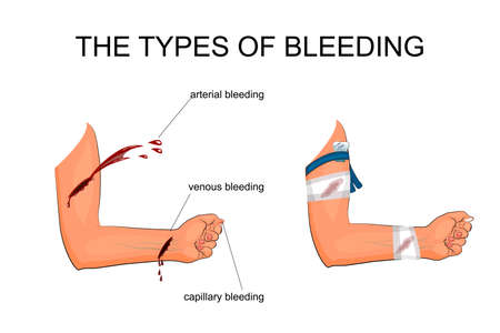 illustration of hand with the types of bleeding. The imposition of hemostatic tourniquet and a pressure bandageのイラスト素材