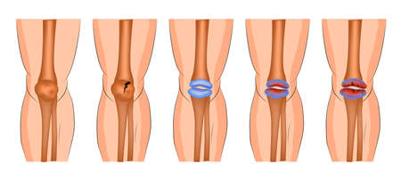 arthritis of the knee joint, protrusion, fracture of the patellaのイラスト素材