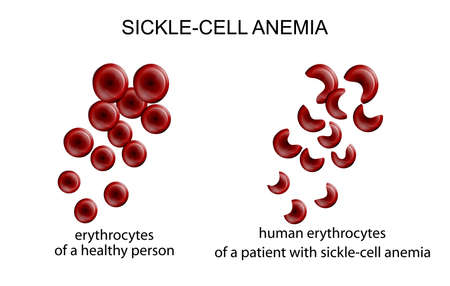 illustration of blood cells in the disease sickle-cell anemiaのイラスト素材