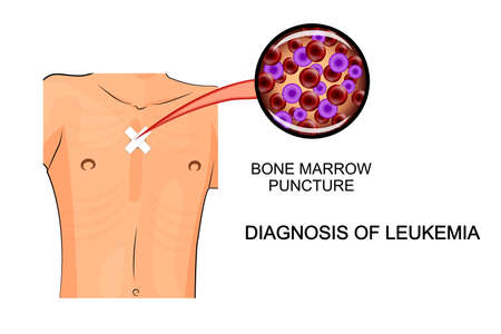leukemia. illustration of analysis of bone marrow biopsyのイラスト素材