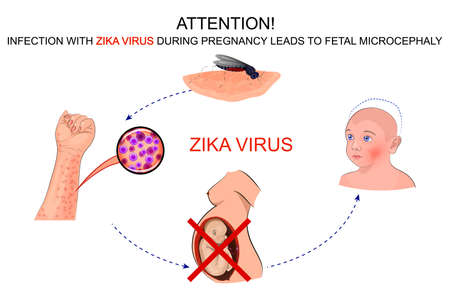 illustration of the effects of infection by zika virus for pregnant womenのイラスト素材