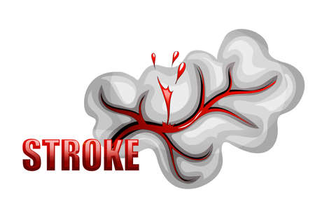 illustration of a rupture of the vessel. hemorrhagic stroke. insult. red blood cells.のイラスト素材