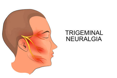 illustration of a male head. trigeminal neuralgia. neuroscienceのイラスト素材