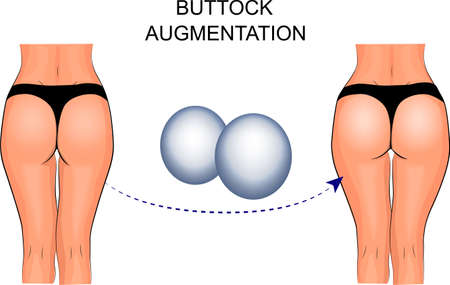 illustration of buttock augmentation.