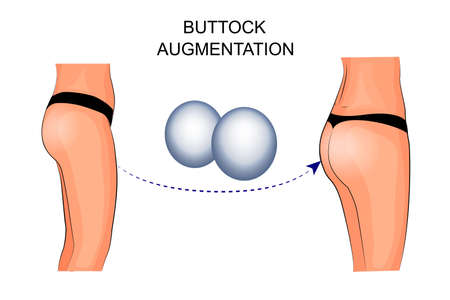 illustration of buttock augmentation.のイラスト素材