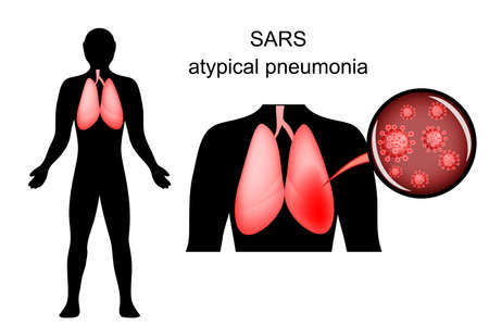illustration of SARS. inflamed lungs and the causative agent. virusのイラスト素材