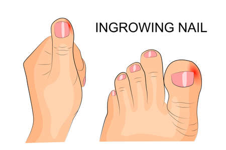 illustration of ingrowing of the nail. the fingers and toes. inflammationのイラスト素材