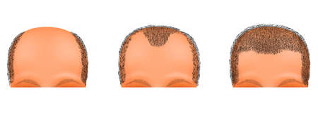 illustration of a male head suffering from baldness. hair transplantationのイラスト素材