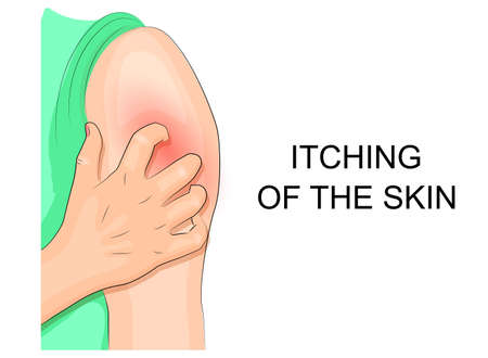 illustration itching skin infection. hand combing shoulderのイラスト素材