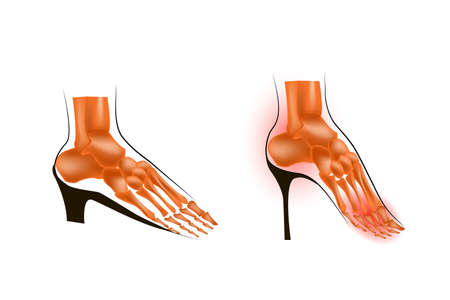 illustration of the skeleton of the foot on a low and a high heelのイラスト素材