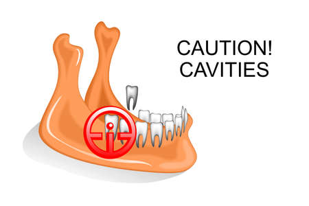 illustration of the lower jaw, the teeth, dental cariesのイラスト素材