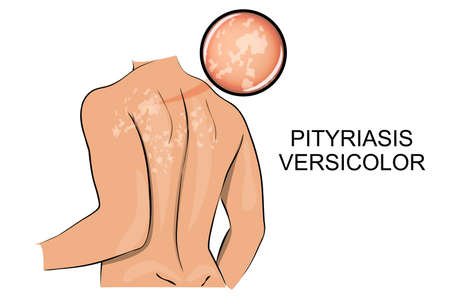 illustration of the back, the affected pityriasis  versicolor. dermatology.のイラスト素材