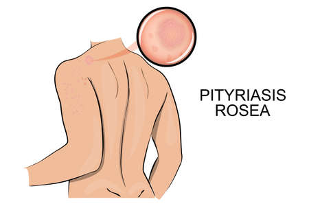 illustration of  pityriasis rosea. dermatology. increase under the microscope.のイラスト素材