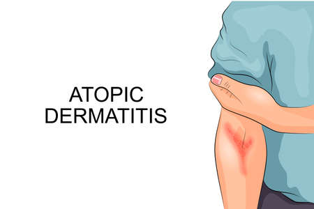 illustration of atopic dermatitis. allergies. dermatology. inflammationのイラスト素材