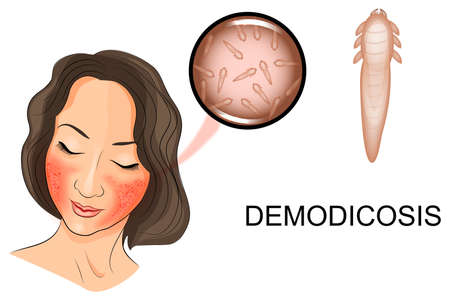 illustration of a woman's face affected by demodicosis. Demodex mite under magnificationのイラスト素材