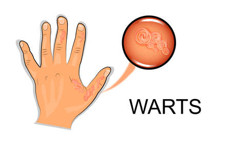 illustration of a hand affected by the wartのイラスト素材