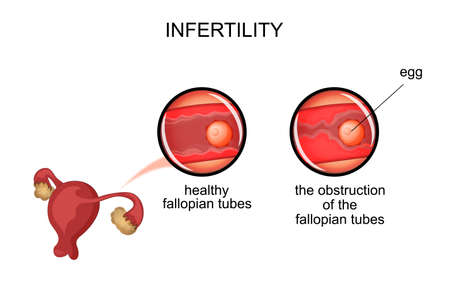 illustration of infertility due to obstruction of the fallopian tubesのイラスト素材