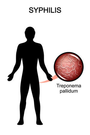 illustration of the causative agent of syphilisのイラスト素材