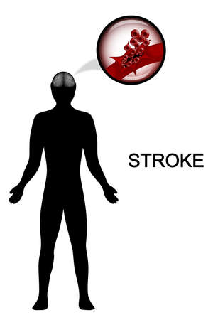 vector medical illustration of the silhouette of a man. the rupture of the vessel headのイラスト素材