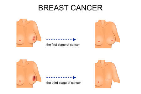 vector illustration for medical publications. carcinoma. surgeryのイラスト素材