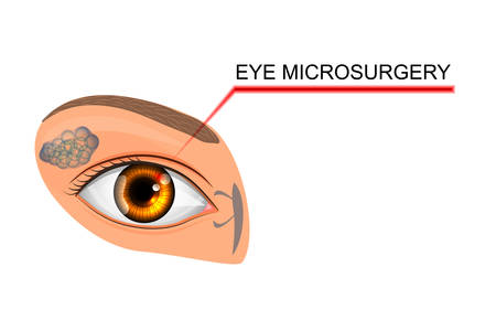 vector illustration of eyes. microsurgery in ophthalmology. for medical publications.のイラスト素材
