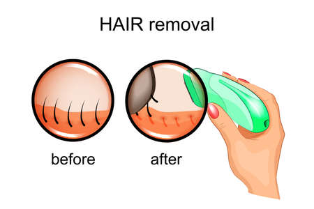 vectory illustration of a hair removal epilatorのイラスト素材