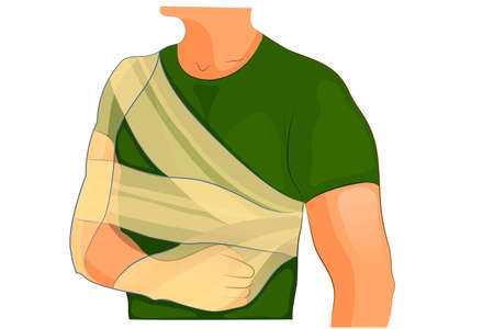 vector illustration of fixation bandages at fractureのイラスト素材