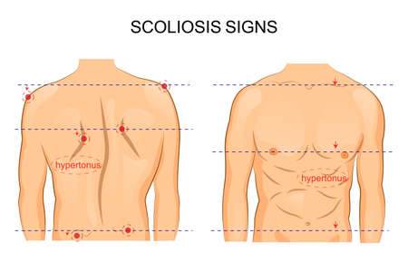 vector illustration of scoliosis of the spine. signsのイラスト素材